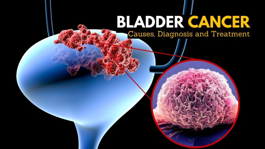 Bladder Cancer - Symptoms & Causes - Gleneagles Hospital