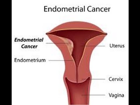 Endometrial Cancer: Causes, Symptoms, and Treatment Explained