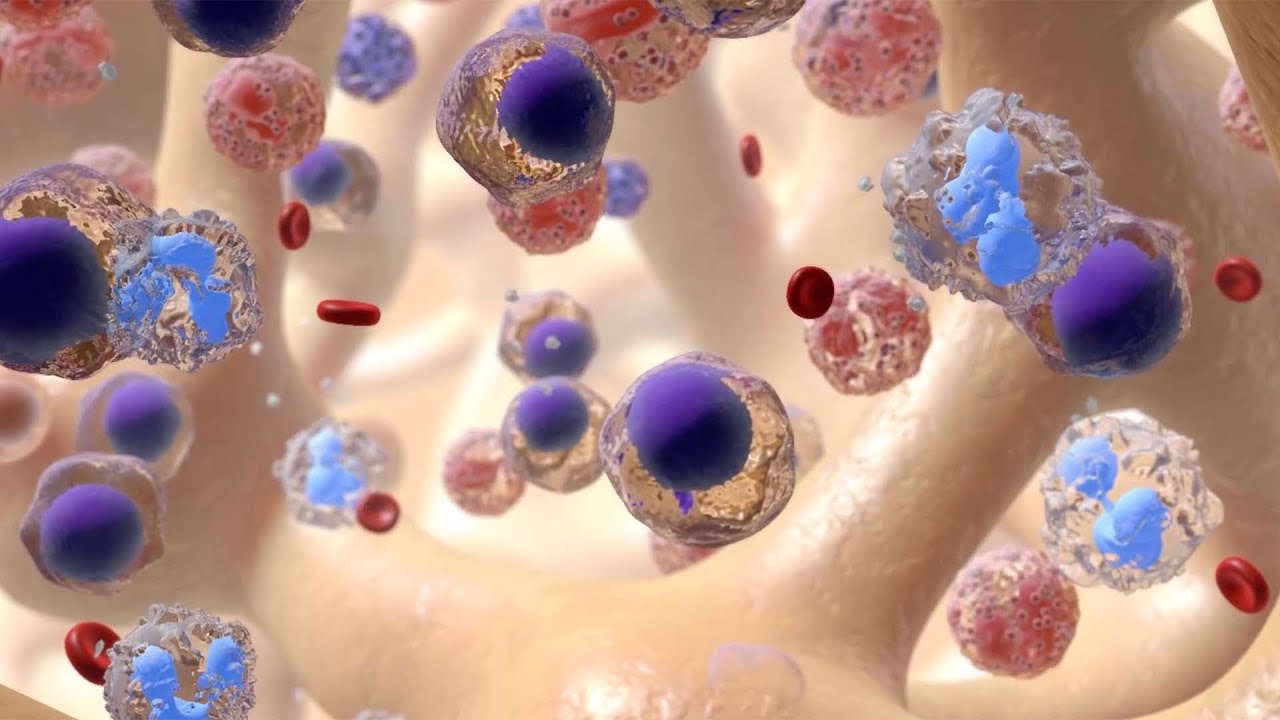 Leukemia: Understanding This Blood Cancer