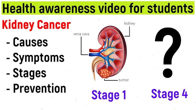 Understanding Kidney Cancer Causes Symptoms and Treatment Options